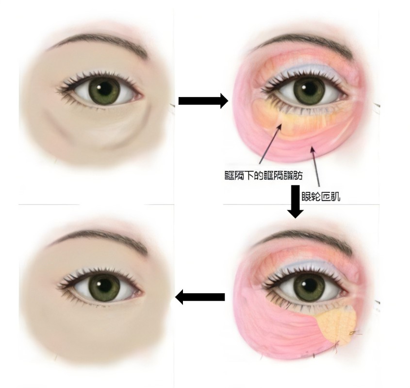 消除眼袋的方法有哪些？