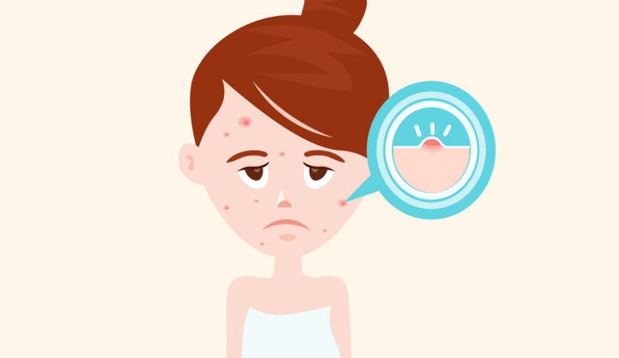 青春痘有救了嗎？聽說青春痘也有疫苗了？